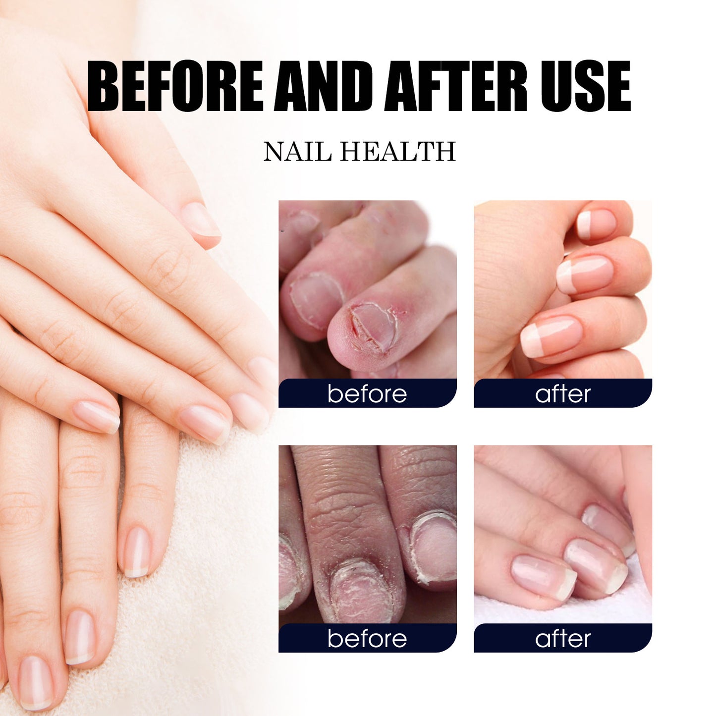 Nail Strengthener Treatment - Repair Soft Weak Nails | Tea Tree Oil 10ml